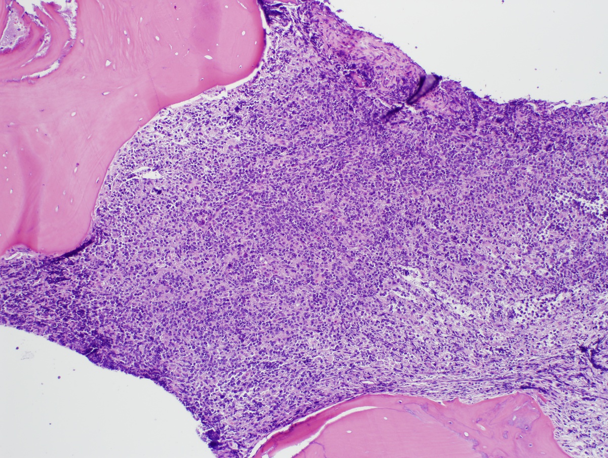 BM biopsy 2 core 10x